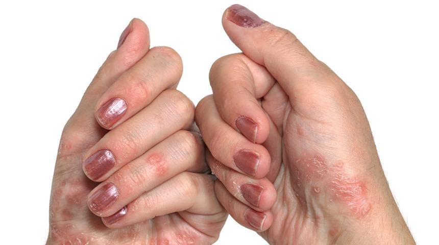 En Detaylı Egzama Rehberi: Nedir? Neden Olur? Nasıl Geçer?