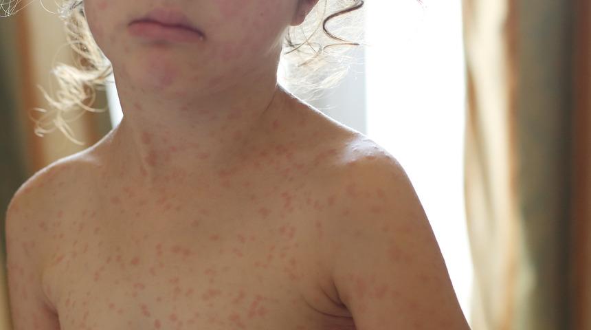 Çocuklara sık banyo yaptırmada egzama riski