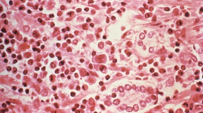 Hantavirüs nedir? İnsandan insana bulaşır mı? 