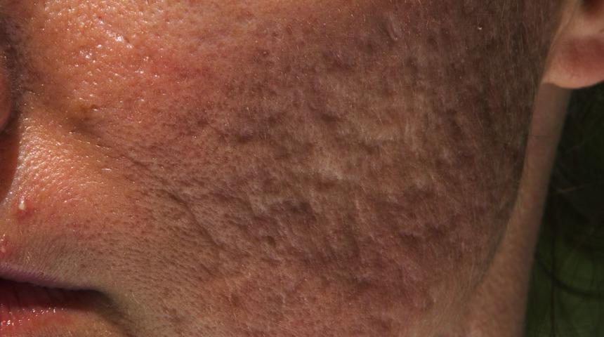 Sivilceden geriye kalan izler nasıl ge&ccedil;er?