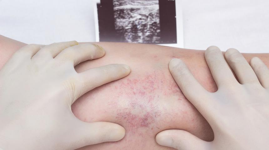 Derin ven trombozu hastaları i&ccedil;in altın değerinde koronavir&uuml;s &ouml;nerileri