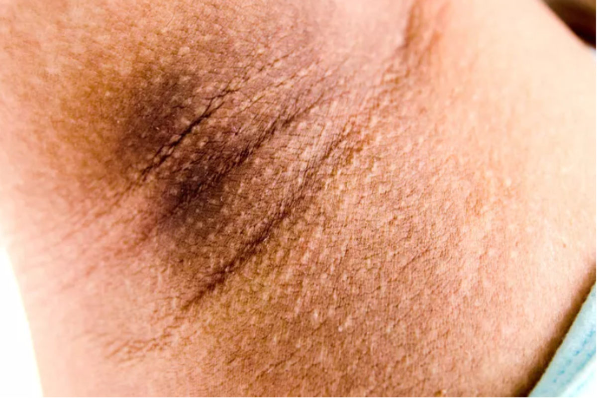 Evde bu y&ouml;ntemlerle koltuk altı kararmasından kurtulabilirsiniz!