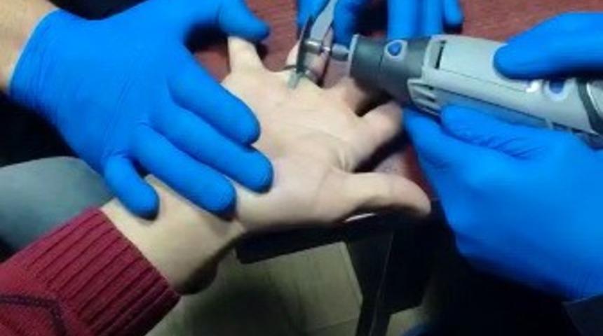 Parmağa sıkışan y&uuml;z&uuml;k kesilerek &ccedil;ıkarıldı