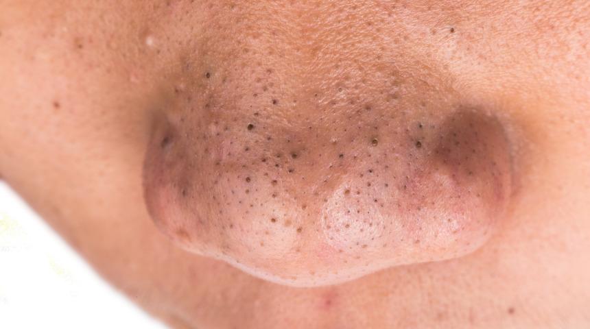 Siyah noktaları geçirmenin ve önlemenin yolları! İşte evdeki çözümler