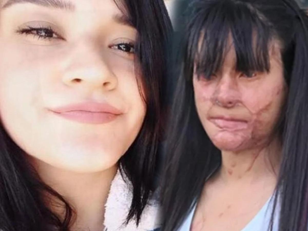 Son dakika: Asitli saldırıya uğrayan Berfin &Ouml;zek şikayetinden vazge&ccedil;ti