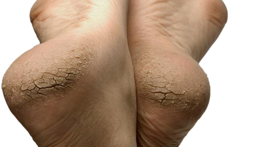 Bu doğal kürlerle ayaklarınızı yumuşacık yapabilirsiniz! Pirinç unu, elma sirkesi...