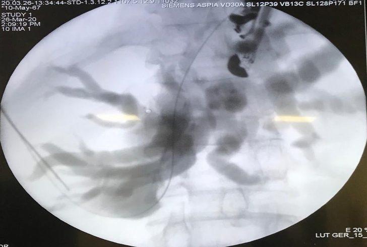 Düzce Üniversitesi Hastanesi’nden Türkiye’de bir ilk G3