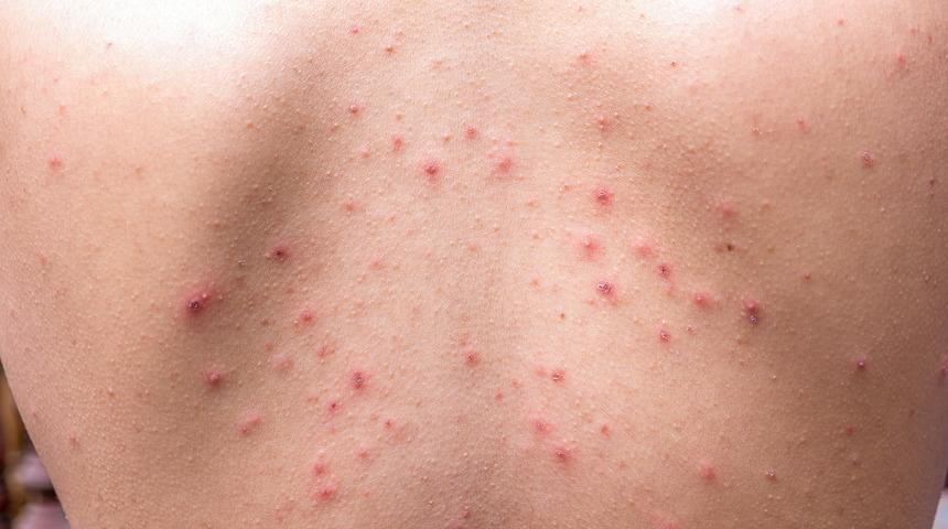 Bunları yerseniz sivilceler farkında olmadan artıyor! Aman dikkat!