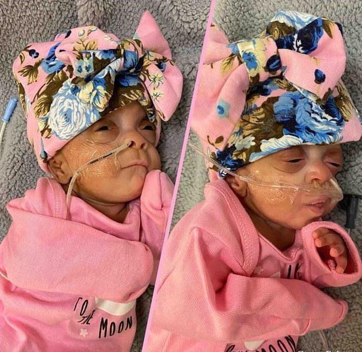 Dünyanın en prematüre ikizleri doğdu! G1