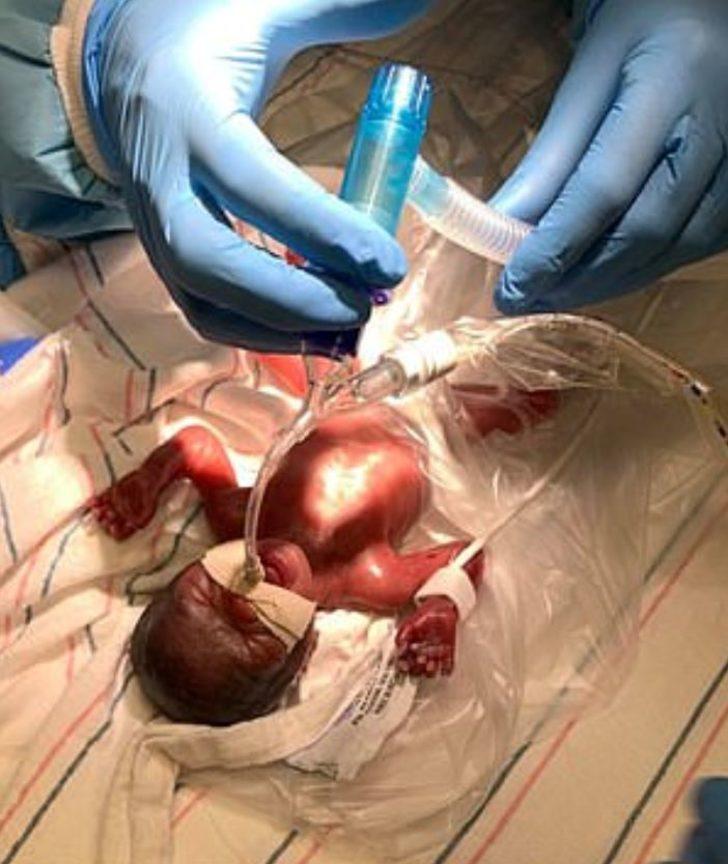 Dünyanın en prematüre ikizleri doğdu! G5