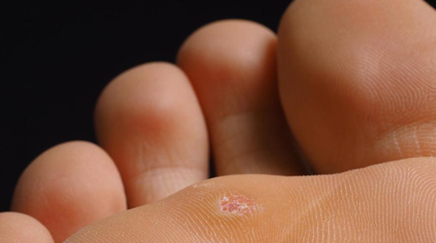 Bu y&ouml;ntem nasırı 1 g&uuml;nde yok ediyor! Sirke...