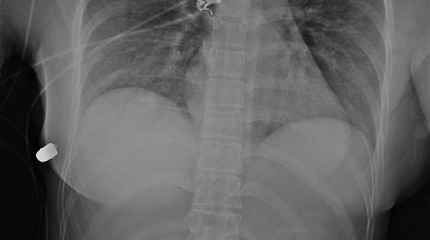 Silikonları sayesinde &ouml;l&uuml;mden d&ouml;nd&uuml;
