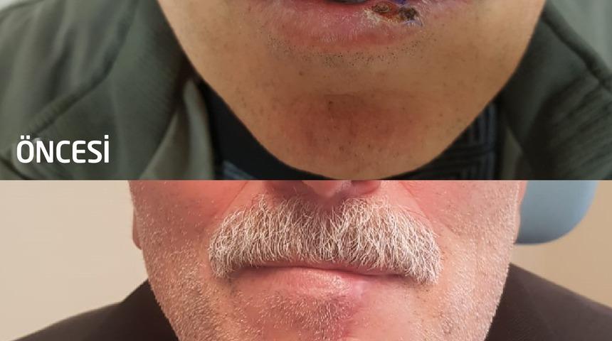 U&ccedil;uk sandığı dudak yarası kanser &ccedil;ıktı