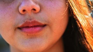 Tüylenme sorununu hafife almayın tümör riski var!