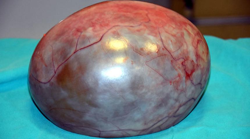 Karnından tam 3 kilo 400 gram kitle &ccedil;ıktı