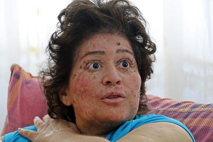 Korona değil güneş eve hapsetti! Organlarını tek tek kaybediyor G1