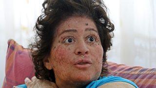 Korona değil güneş eve hapsetti! Organlarını tek tek kaybediyor