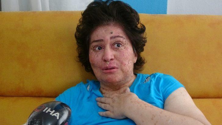 Korona değil güneş eve hapsetti! Organlarını tek tek kaybediyor G3