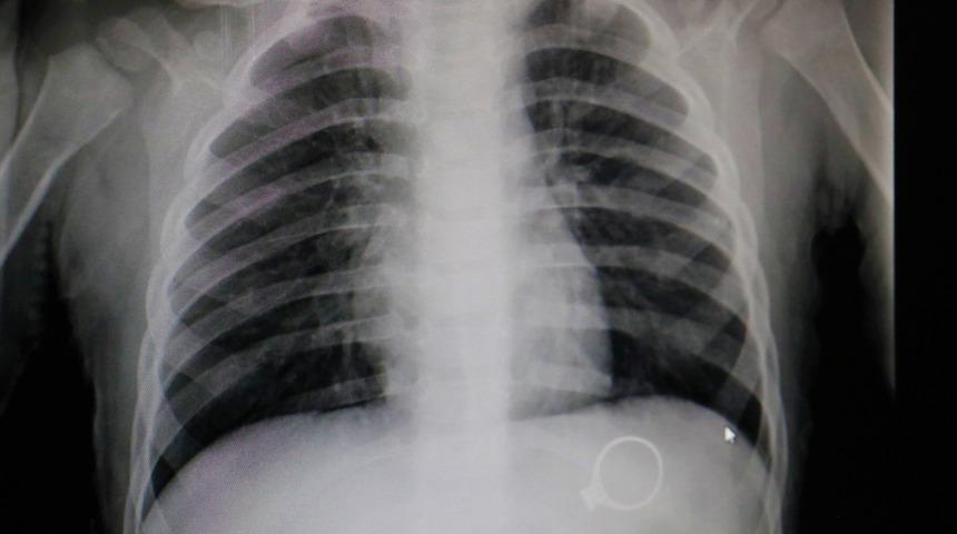 1.5 yaşındaki bebek, 3 bin liralık tek taş yüzüğü yuttu!