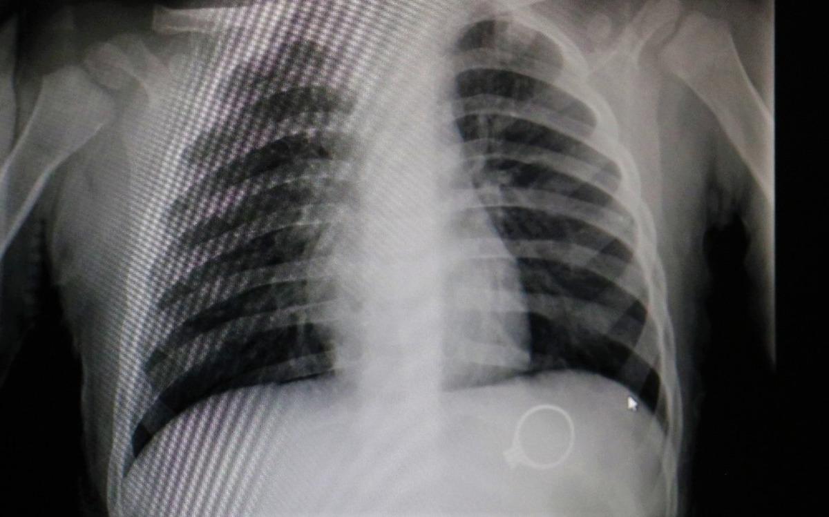 1,5 yaşındaki bebek annesinin 3 bin liralık y&uuml;z&uuml;ğ&uuml;n&uuml; yuttu!