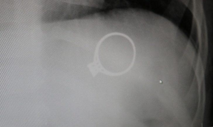 1,5 yaşındaki bebek annesinin 3 bin liralık yüzüğünü yuttu! G2