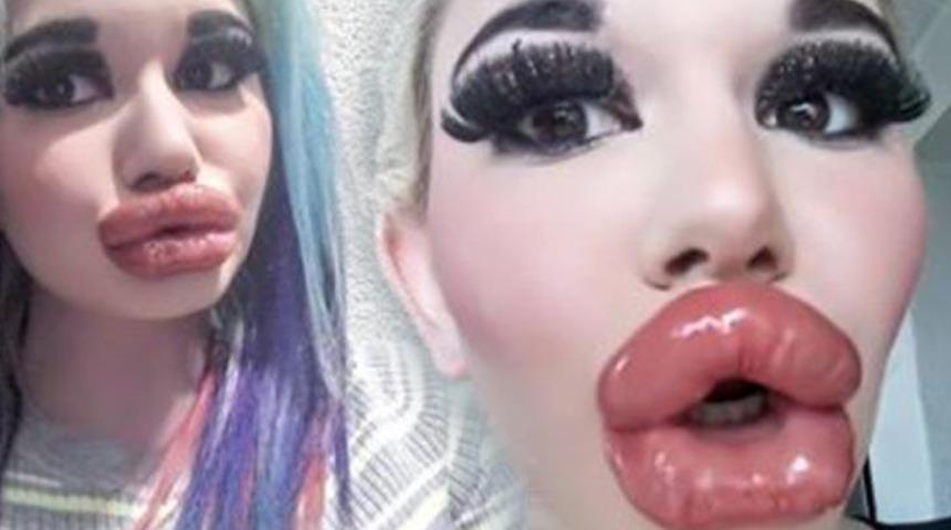 Dünyanın en dolgun dudaklarına sahip olan kadın daha büyük dudaklar istiyor