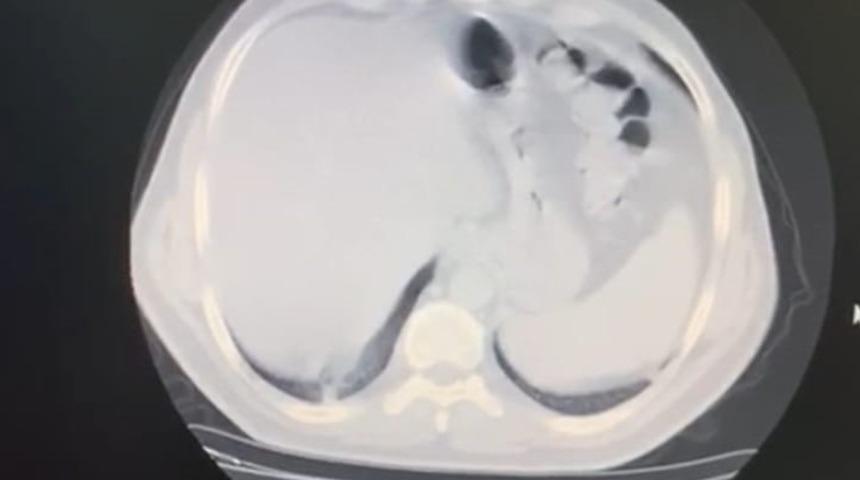 Koronavir&uuml;s&uuml; yenen doktor: Bilin&ccedil; kaybı yaşadım, akciğerimin y&uuml;zde 70&rsquo;ini vir&uuml;s kaplamıştı