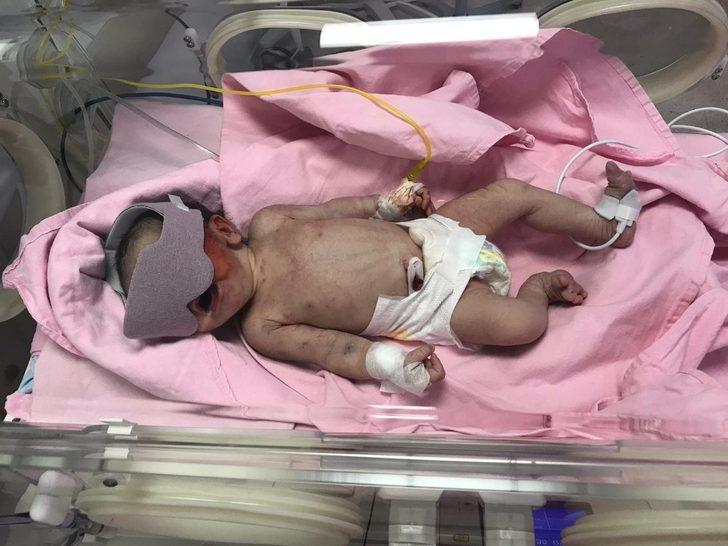 Çöpte bulunan bebek yaşam savaşı veriyor G5