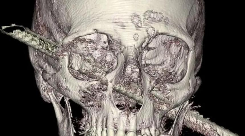 Mucize ameliyat: Beynine demir çubuk saplandı