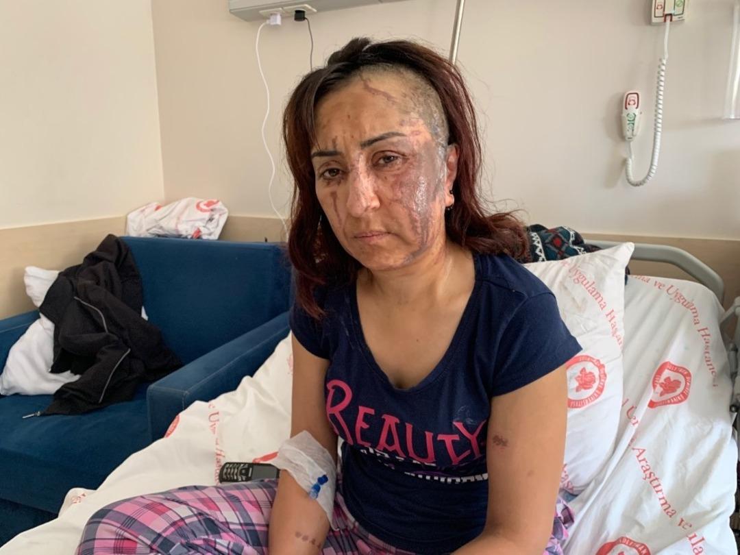 Şiddet g&ouml;rd&uuml;ğ&uuml; eşinden boşanmak istedi diye kezzaplı saldırıya uğradı!