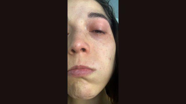 Alondra Torres'in yüzüne çamaşır suyu atıldı.