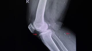 Dizdeki sıvı kaybına ne iyi gelir? Dizde sıvı kaybı neden olur, ameliyatsız nasıl tedavi edilir?