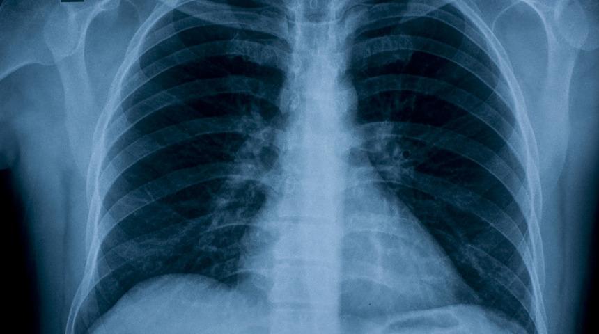 Balgam Nasıl Atılır? Balgam Söktürücü Tarifler, İlaçlar ve Bitkiler