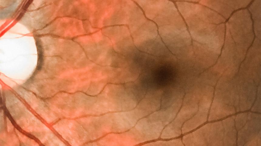 Göz Tansiyonu Rehberi: Nedir? Belirtileri Neler? Kaç Olmalı?