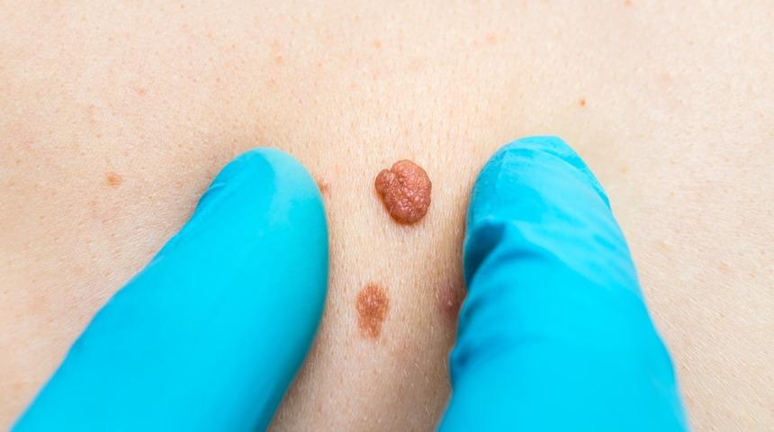 Hamilelik cildinizi de değiştirir! Cildinizde fark edebileceğiniz 11 önemli değişim