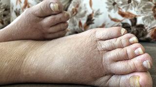 En Detaylı Fil Hastalığı Rehberi: Nedir? Tedavisi ve Belirtileri