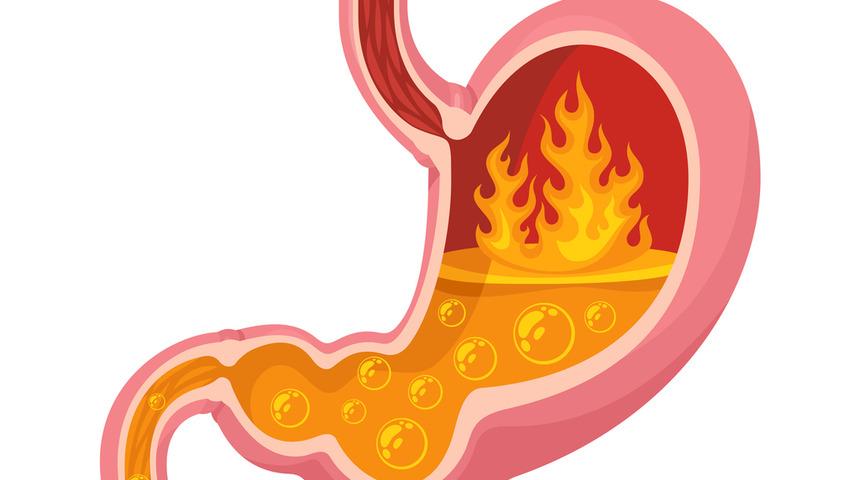 En Detaylı Reflü Rehberi: Nedir? Belirtileri Nelerdir? Nasıl Geçer?