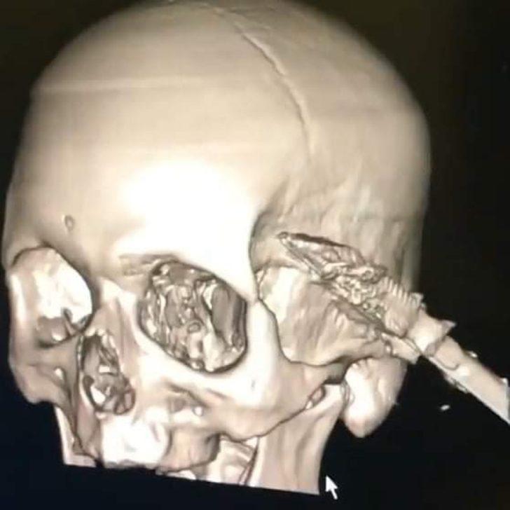 Uyuduğu sırada koltuktan düştü! Başına soba maşası saplandı G1