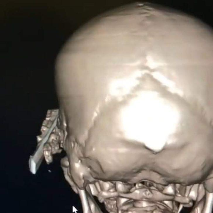 Uyuduğu sırada koltuktan düştü! Başına soba maşası saplandı G2