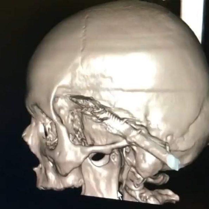 Uyuduğu sırada koltuktan düştü! Başına soba maşası saplandı G3