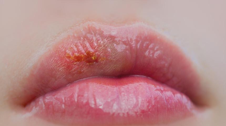 Aromalı dudak nemlendiricisi kullanırken dikkat!