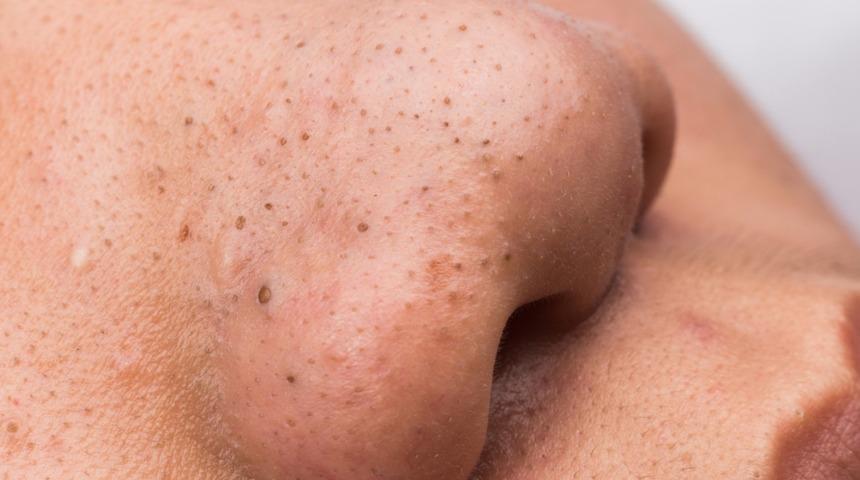 Bu doğal yöntemler siyah noktaları yok ediyor! Yulaf, limon suyu...