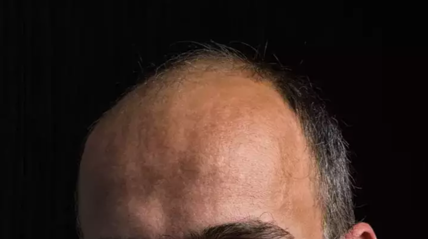 Kel erkekler koronavirüs semptomları açısından daha fazla risk altında