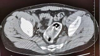 Karın ağrısı şikayetiyle hastaneye gitti, rektumundan balık çıktı