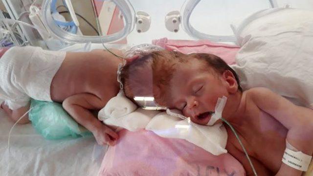 Güzel haberi Cumhurbaşkanı Erdoğan vermişti! İşte ikizlerin son halleri