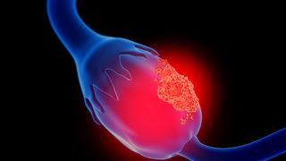 Yumurtalık kanseri tedavisinde VATS ameliyatı