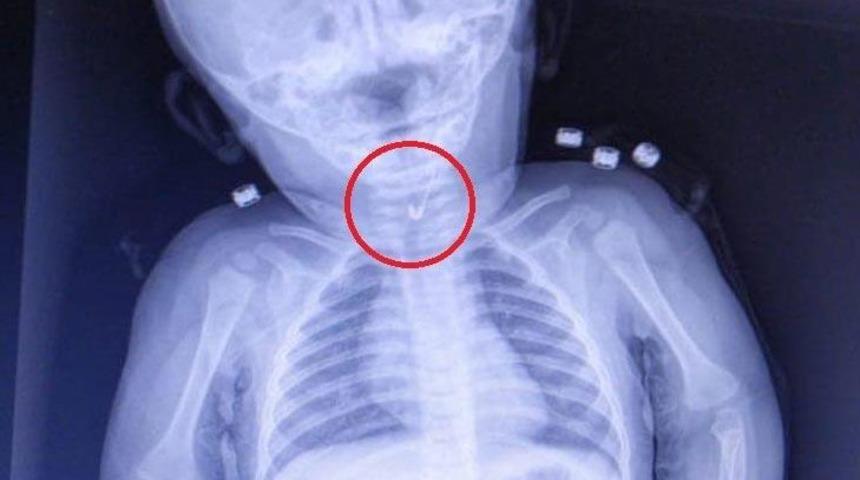 7 aylık bebeğin yemek borusundan &ccedil;engelli iğne &ccedil;ıktı!