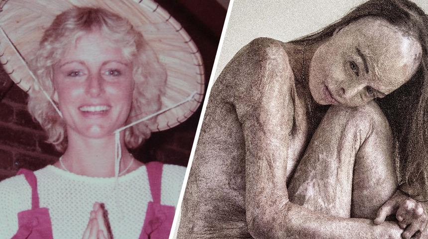 V&uuml;cudunun y&uuml;zde 85&rsquo;i yanan Avustralya g&uuml;zellik krali&ccedil;esi &ccedil;ıplak poz verdi