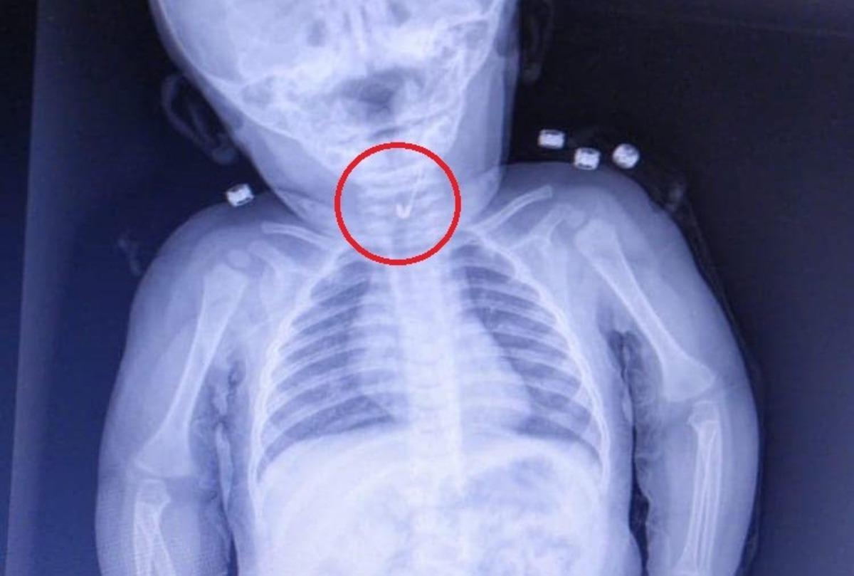 7 aylık bebeğin yemek borusuna ucu a&ccedil;ık &ccedil;engelli iğne takıldı!