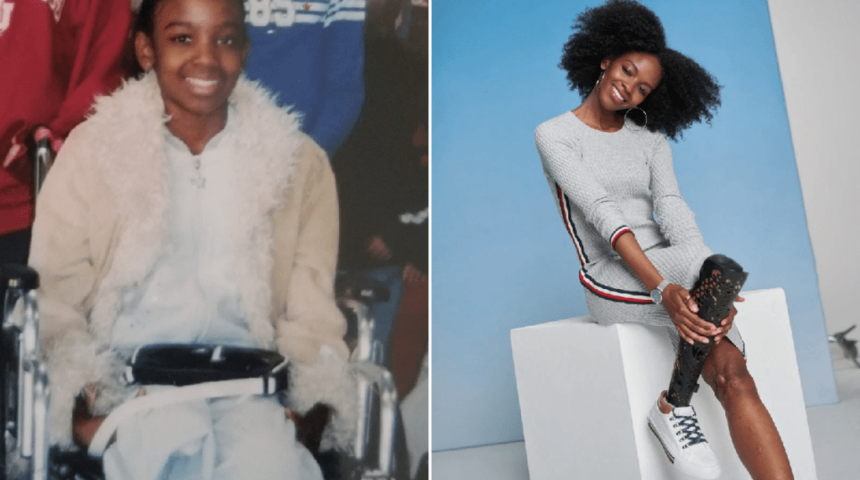 Çocukken sarhoş sürücünün çarpmasıyla bir bacağını kaybeden kadın Vogue modeli oldu